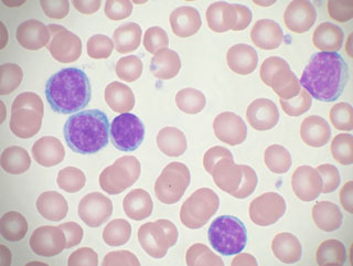 leucemia linfocitica cronica