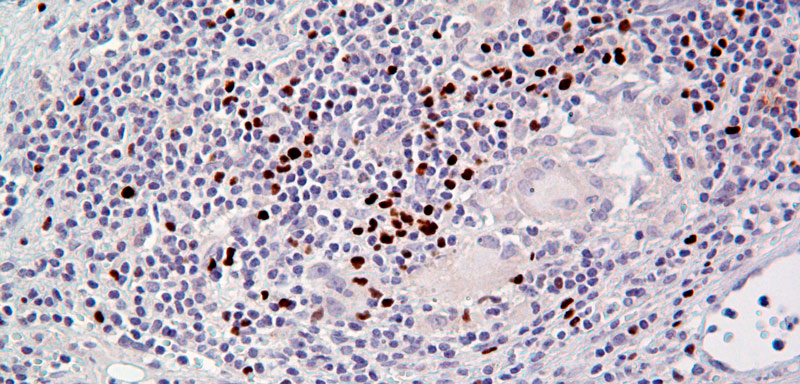 1-tumorhepati0918.jpg