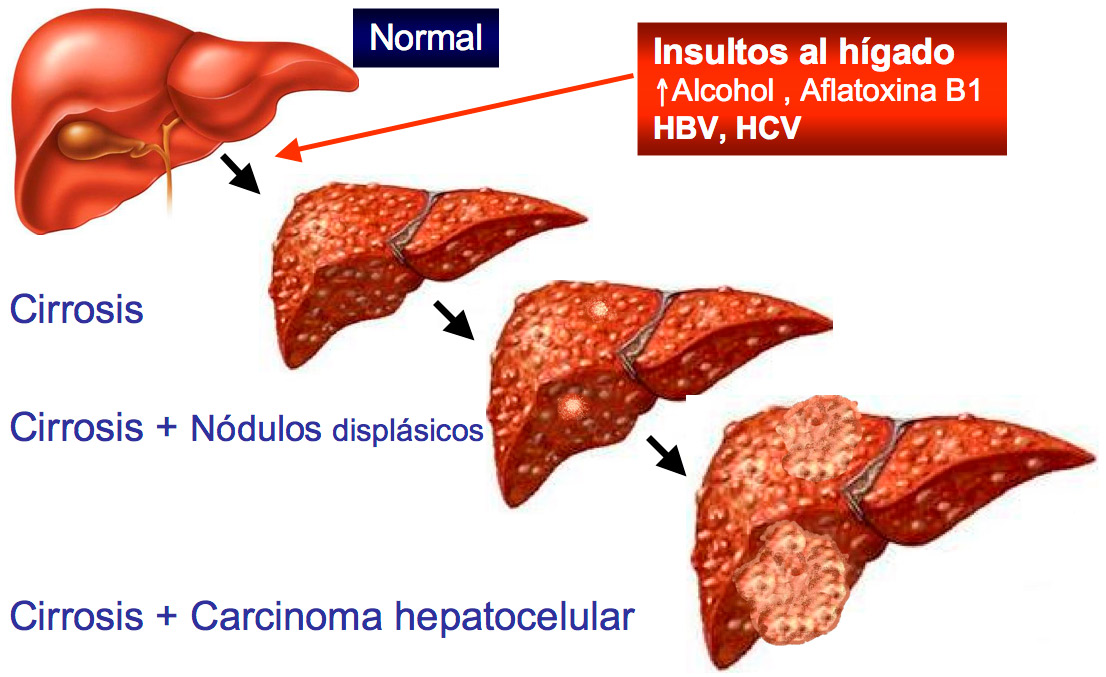 Evolución-del-cáncer-de-hígado.jpg