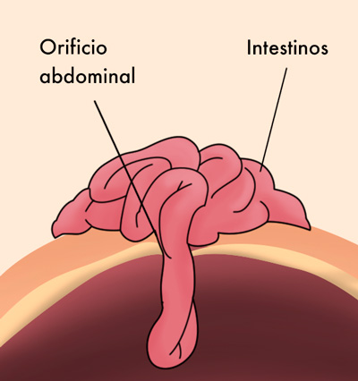 pared abdomen irificio gastrosquisis